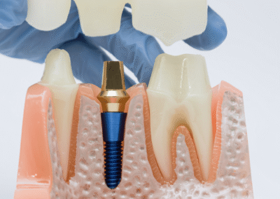 Implantología Oral